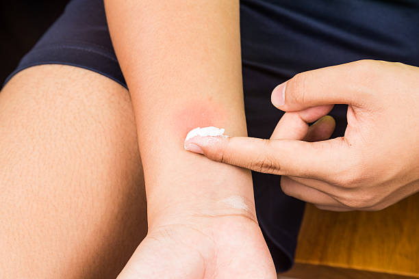 Baking soda being used to relieve itching from insect bites. Baking soda being used to relieve itching from insect bites bug bite photos stock pictures, royalty-free photos & images