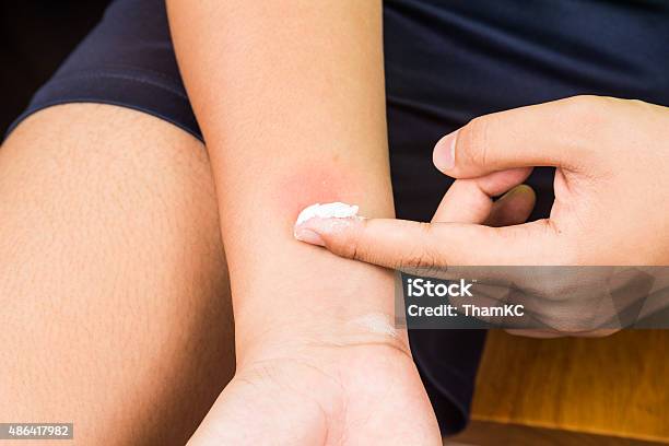 Baking Soda Being Used To Relieve Itching From Insect Bites Stock Photo - Download Image Now