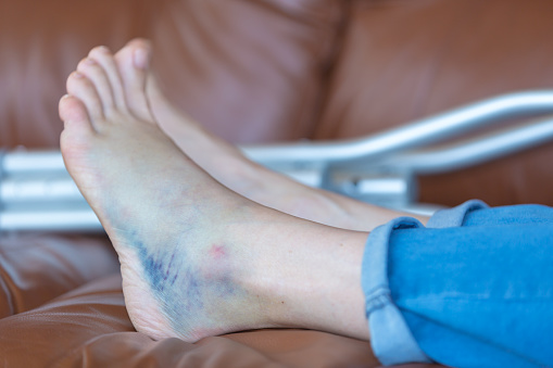 Injured Woman Walking With Crutches after second degree ankle sprain. The woman is laying down on a brown leather sofa.
