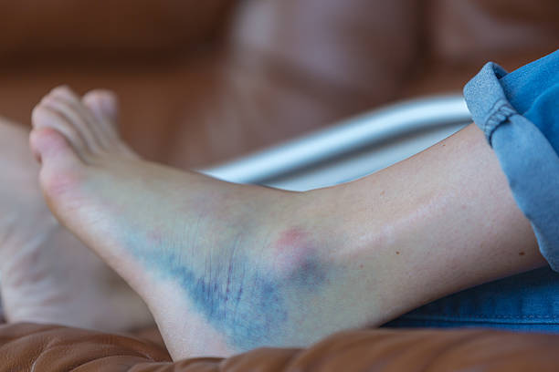 istock Injured Woman Walking With Crutches 486503044