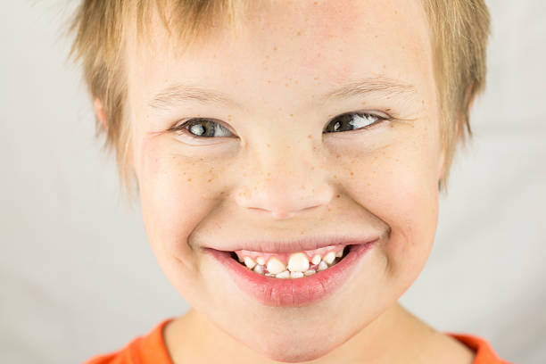 Face of a young boy with Downs Syndrome