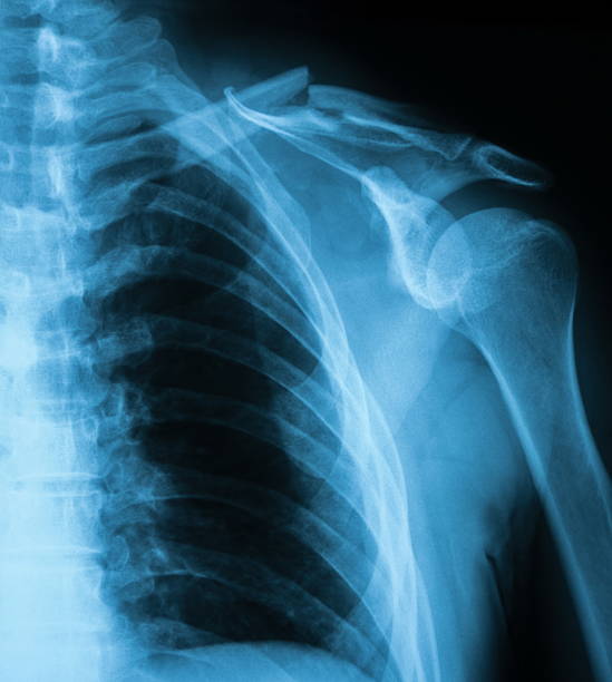 image au rayon x de la clavicule fissure, ap. - x ray x ray image shoulder human arm photos et images de collection