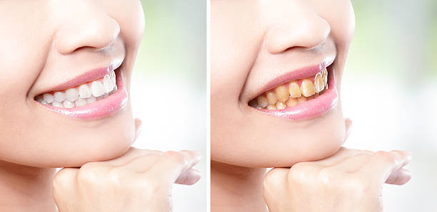 istock woman teeth before and after whitening 486550637