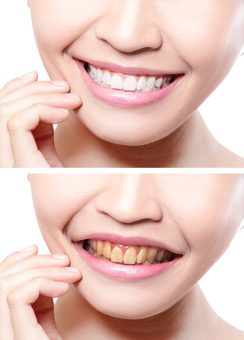 woman teeth before and after whitening. asian beauty model