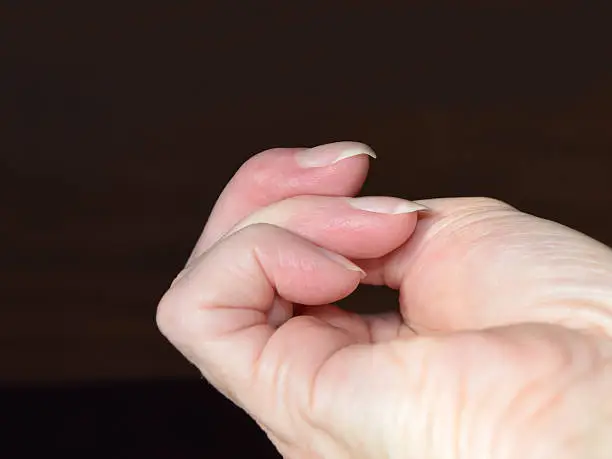 This is a photo of woman's finger with a bent hooked fingernail