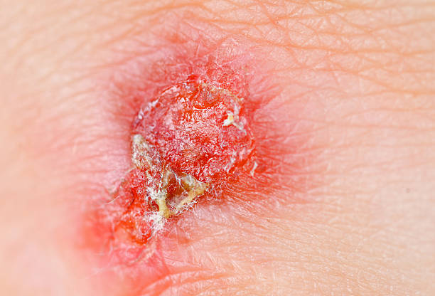 Medical care Extreme close up of a red skin burn scab arm stock pictures, royalty-free photos & images