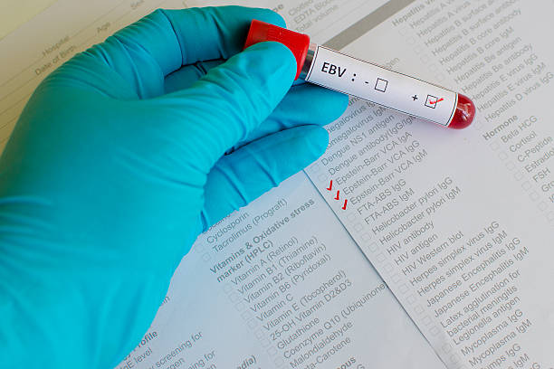 Epstein-Barr virus (EBV) positive Blood sample with Epstein-Barr virus (EBV) positive epstein barr virus photos stock pictures, royalty-free photos & images