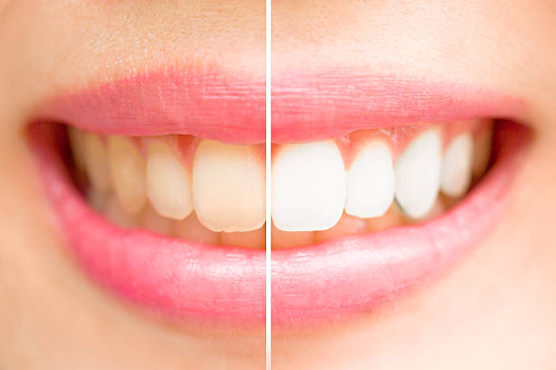 istock Close-up teeth female between before and after brush the teeth. 486723652