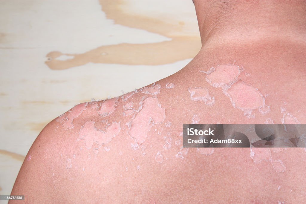 Sunburned back Sunburned peeling on back body a man Boys Stock Photo