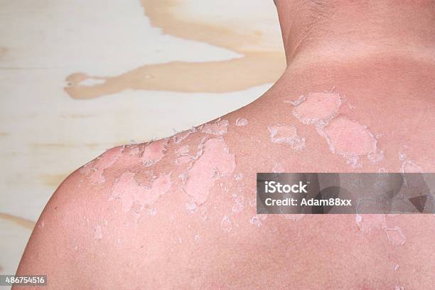 Sunburned Back Stock Photo - Download Image Now - Boys, Sunburned, 2015