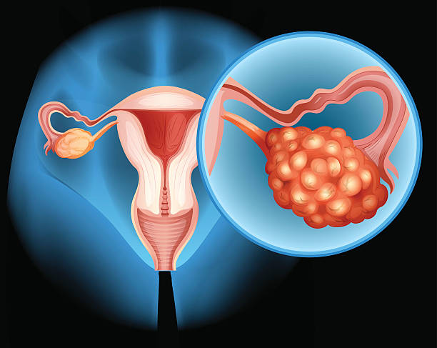 Ovarian cancer diagram in detail Ovarian cancer diagram in detail illustration ovarian cancer stock illustrations