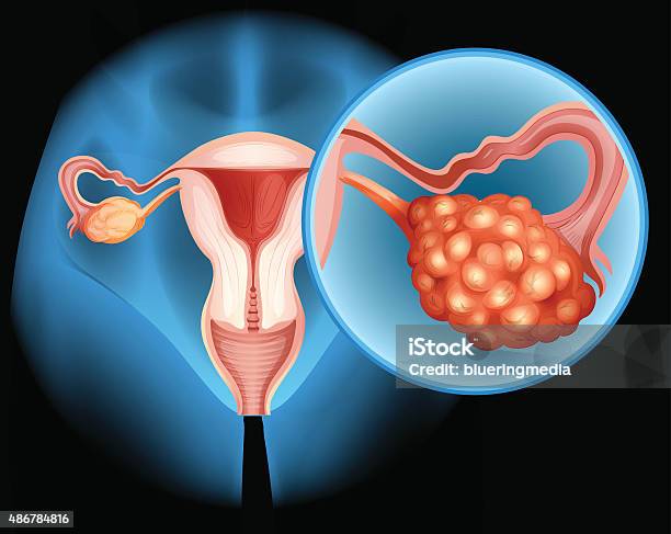 Ovarian Cancer Diagram In Detail Stock Illustration - Download Image Now - Ovarian Cancer, Anatomy, Biology