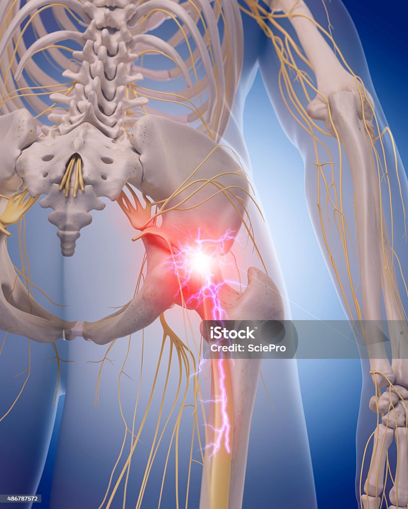 medical illustration medically accurate illustration of a painful sciatic nerve Sciatic Nerve Stock Photo