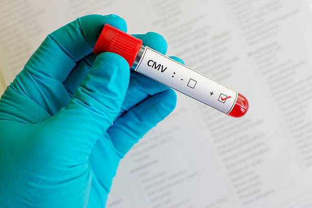 cytomegalowirusa (cytomegalovirus, cmv) dodatni - cmv zdjęcia i obrazy z banku zdjęć