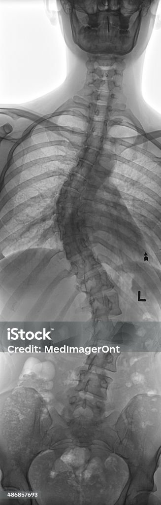 Scoliose x-ray - Photo de Rayon X libre de droits