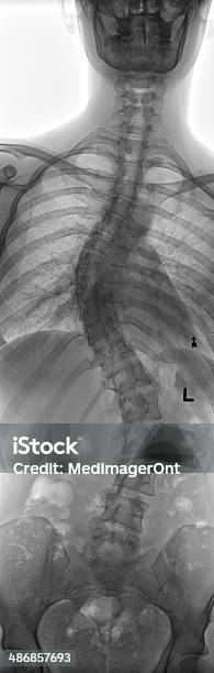 Photo libre de droit de Scoliose Xray banque d'images et plus d'images libres de droit de Rayon X - Rayon X, Scoliose, Colonne vertébrale humaine