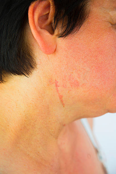 istock Postoperative scar of carotid surgery 486887684