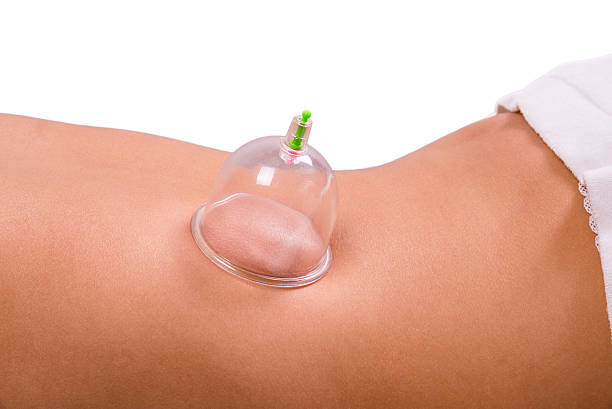 Cupping therapy stock photo