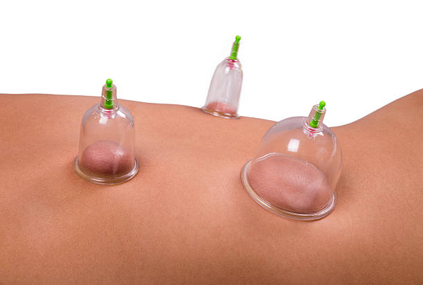 Cupping therapy stock photo