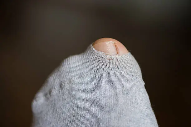 Big Toe of left foot coming through a little hole in a torn sock made of grey cotton