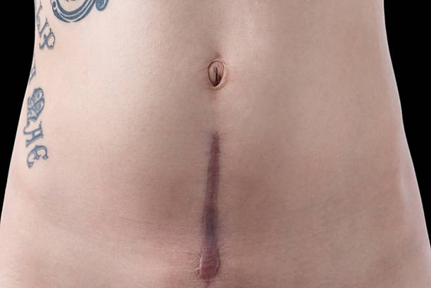 Mothers Recovering Csection Scar With Tattoo Stock Photo - Download Image  Now - Tattoo, Black Color, Caesarean Section - iStock