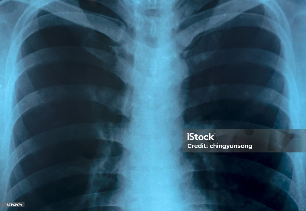 Imagem de raios X Close-up do Homem do peito - Foto de stock de 2015 royalty-free