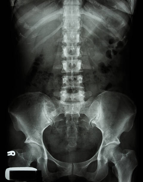 X-ray lumbo-sacral spine and pelvis of asian adult people stock photo