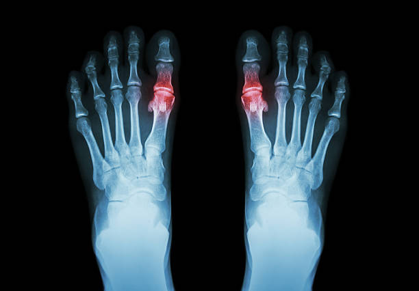 Gout , Rheumatoid arthritis Gout , Rheumatoid arthritis ( Film x-ray both foot and arthritis at first metatarsophalangeal joint ) ( Medicine and Science background ) joint body part photos stock pictures, royalty-free photos & images