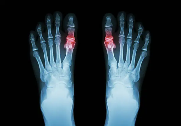 Gout , Rheumatoid arthritis ( Film x-ray both foot and arthritis at first metatarsophalangeal joint ) ( Medicine and Science background )