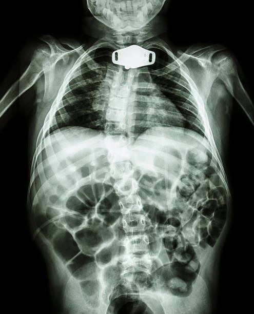 X-ray body of child and tracheostomy tube X-ray body of child and tracheostomy tube at neck area due to respiratory failure tracheotomy tubing stock pictures, royalty-free photos & images