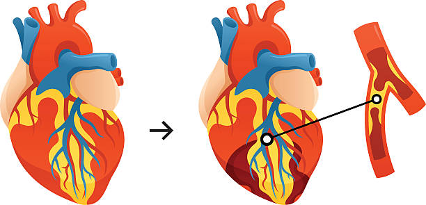 illustrations, cliparts, dessins animés et icônes de crise cardiaque - artère humaine