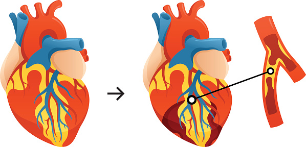 Conceptual illustration representing a heart affected by a heart attack in comparison to a healthy heart.