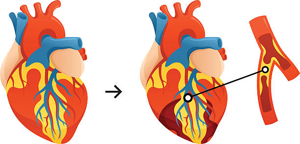 Heart Attack Conceptual illustration representing a heart affected by a heart attack in comparison to a healthy heart. colesterol stock illustrations