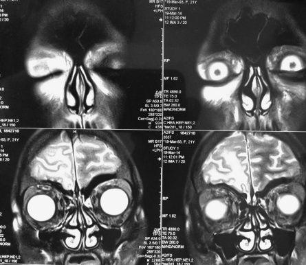 MRI of a frightened human