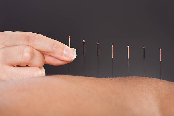 Acupuncture Treatment Close-up Of A Person Getting An Acupuncture Treatment At Spa acupuncture photos stock pictures, royalty-free photos & images