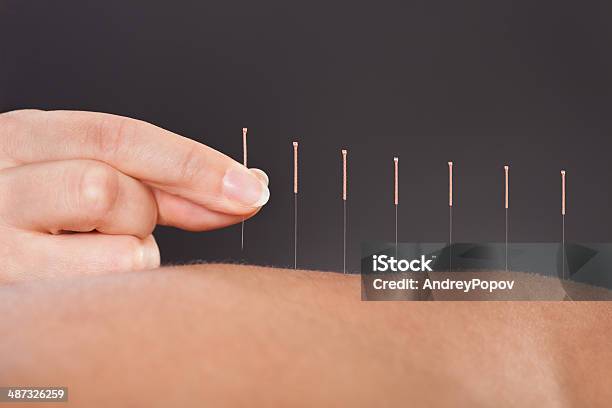 Acupuncture Treatment Stock Photo - Download Image Now - Acupuncture, Acupuncturist, Men