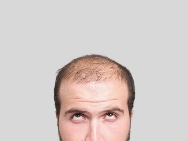 bald jeune homme, vue de devant - balding photos et images de collection