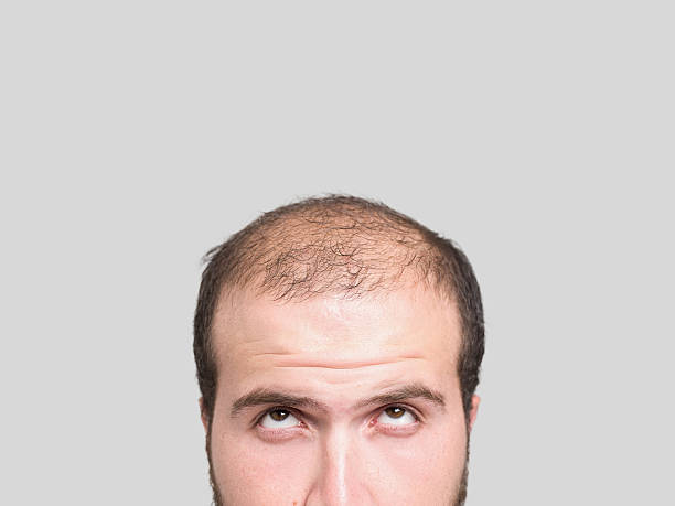 Bald young man, front view Close up of bald young man, front view hair loss stock pictures, royalty-free photos & images