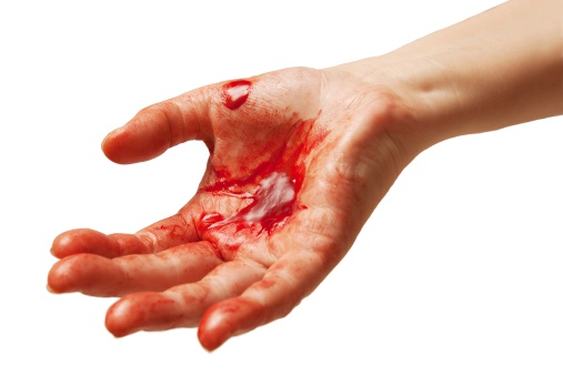 Bloody hand symbolizing injury or crime.