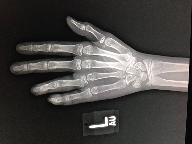 Hand X-Ray stock photo