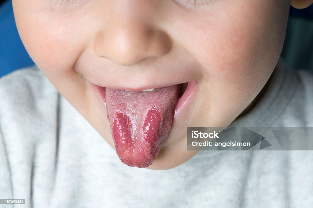 Disease symptoms of geographic tongue Geographic tongue disease in a young child. Inflammation Stock Photo