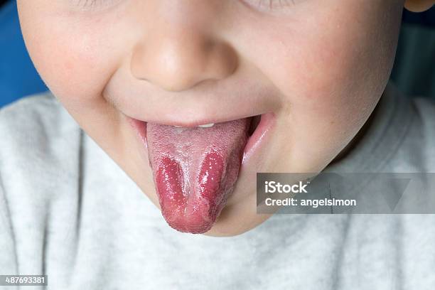 Disease Symptoms Of Geographic Tongue Stock Photo - Download Image Now - Inflammation, Bacterium, Boys