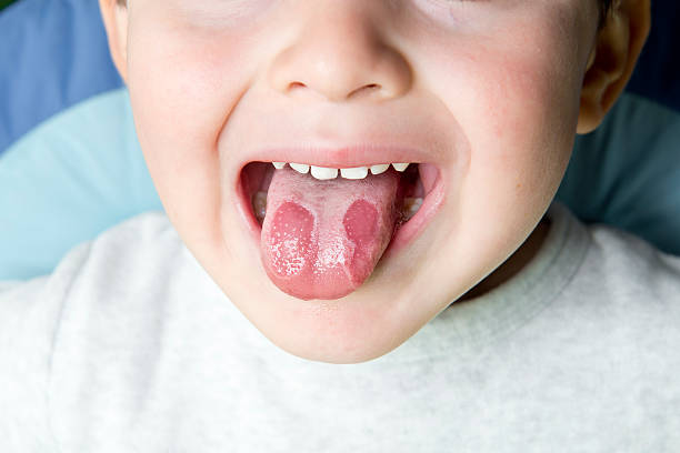 Geographic tongue disease in a child stock photo