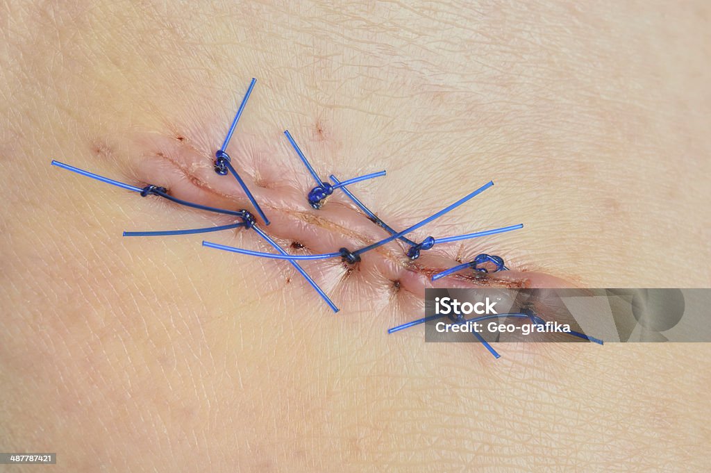 Простроченные раны после биопсии кожи на женской ноге. - Стоковые фото Боль роялти-фри