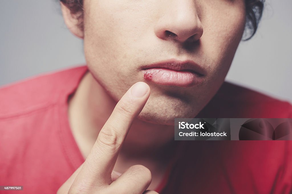 Young man with cold sore Young man is showing a cold sore on his lip Herpes Stock Photo