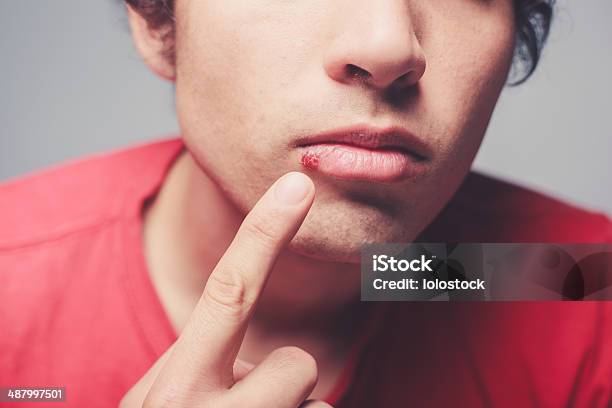 Young Man With Cold Sore Stock Photo - Download Image Now - Herpes, Cold Sore, Human Lips
