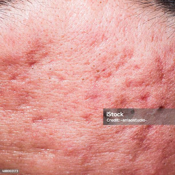 Ill Skin Disease Whelk Pimple On Face Stock Photo - Download Image Now - Acne, Adult, Allergy