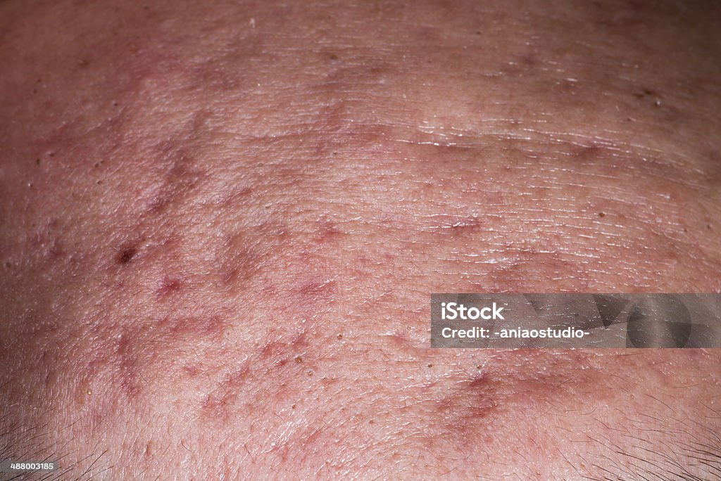 Doente pele doença, Búzio espinha cutânea na face. - Royalty-free Acne Foto de stock