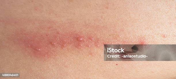 Mal Doença Cutânea Eczema - Fotografias de stock e mais imagens de Alergia - Alergia, Condição, Cor de rosa