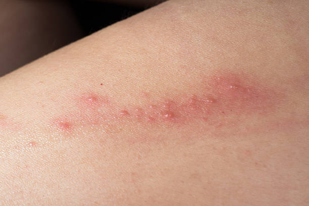 istock ill skin disease eczema 488049195